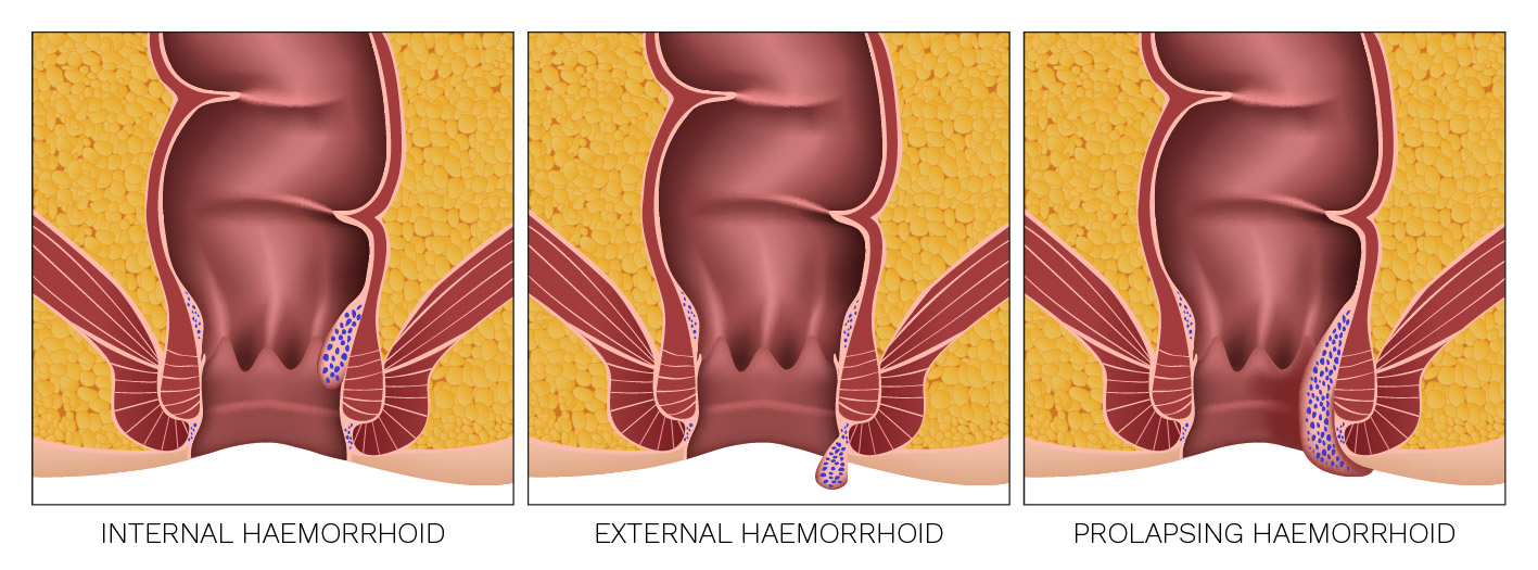 Klasifikácia a symptomatológia hemoroidov.Vonkajšie a vnútorné hemoroidy